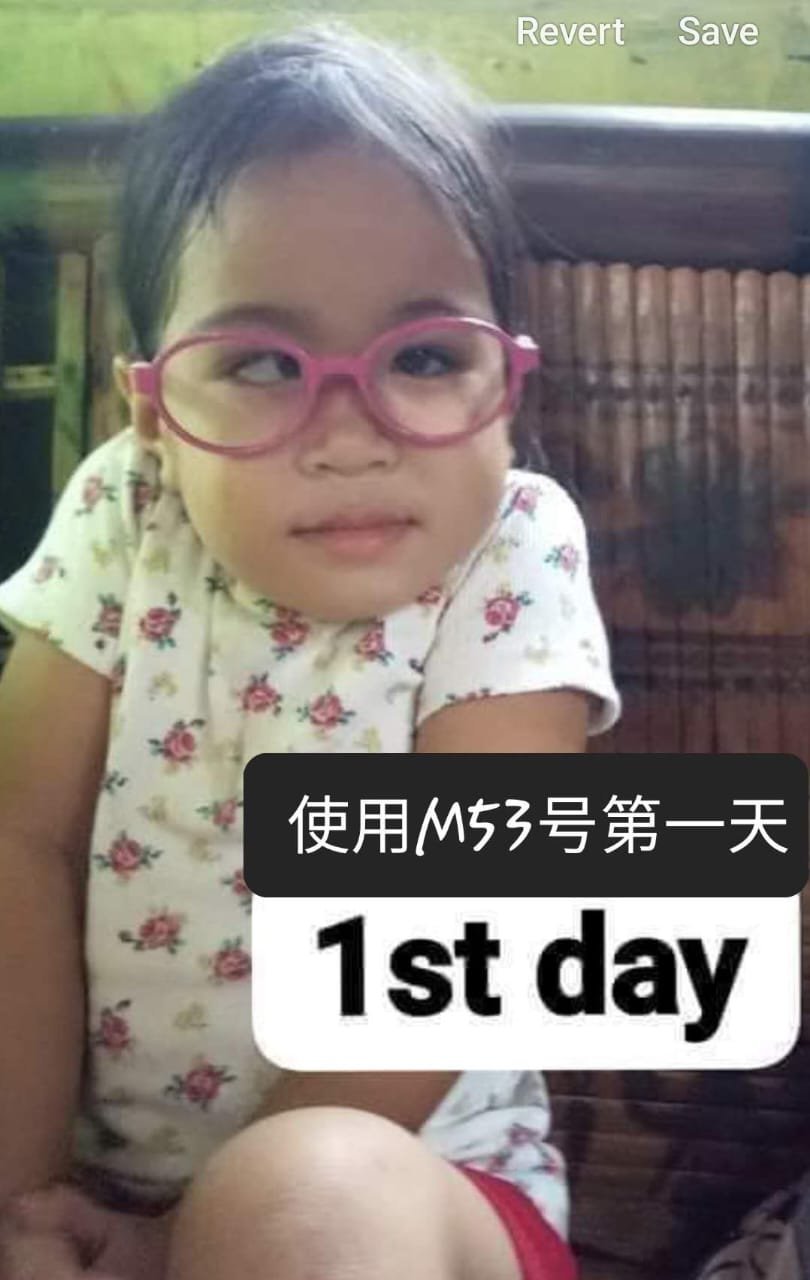小孩斜视14天临床成功案例 第一天