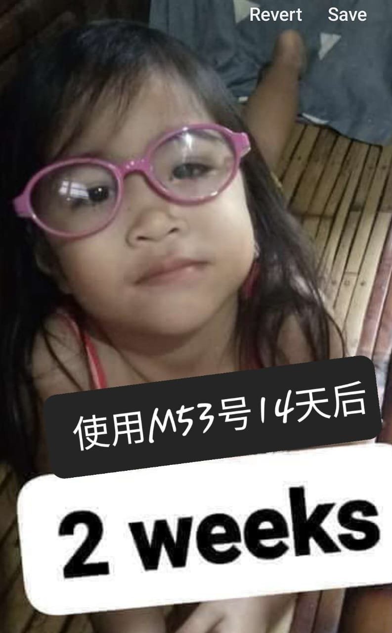 小孩斜视14天临床成功案例 2 weeks