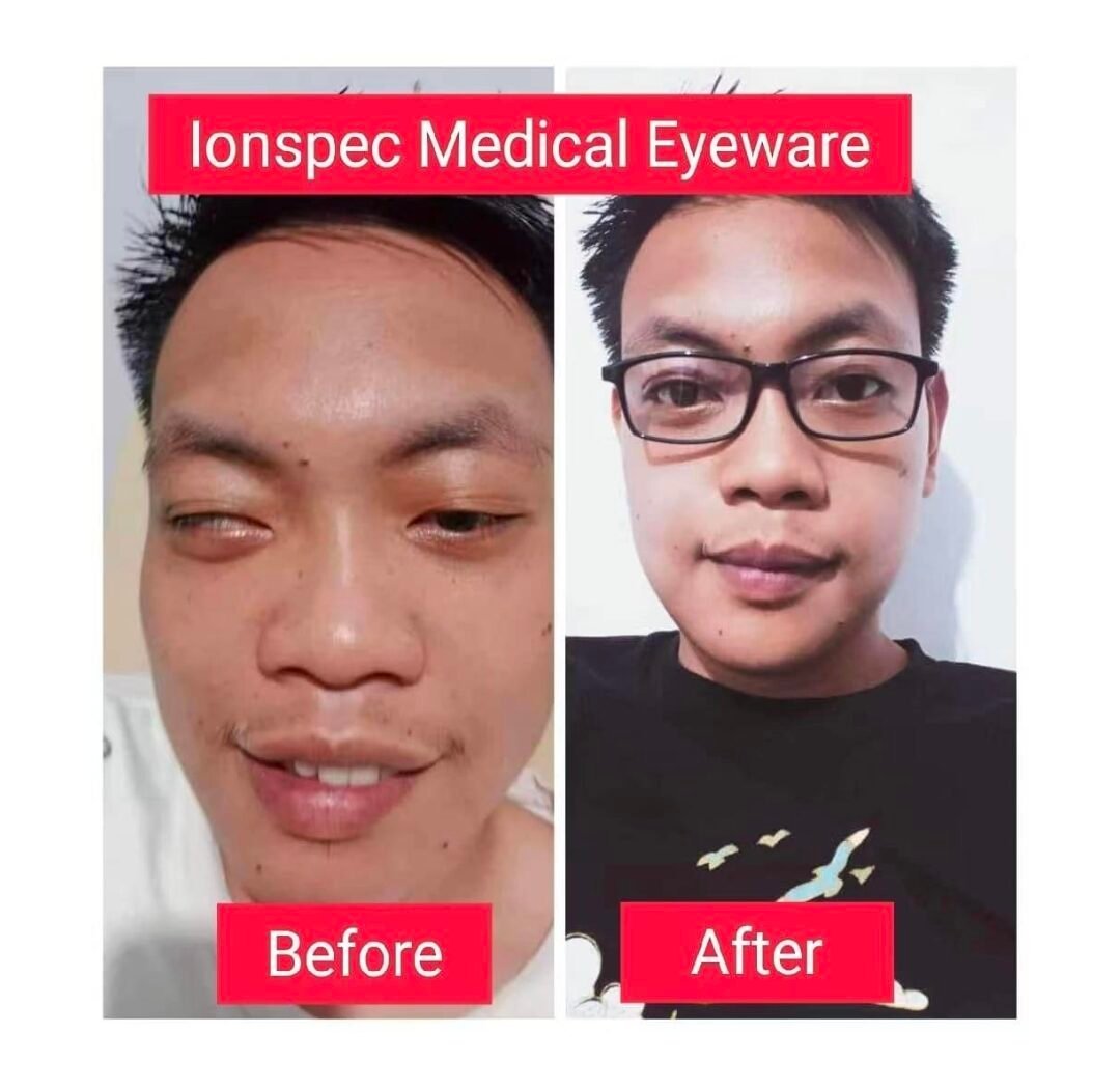 懒惰眼临床成功案例