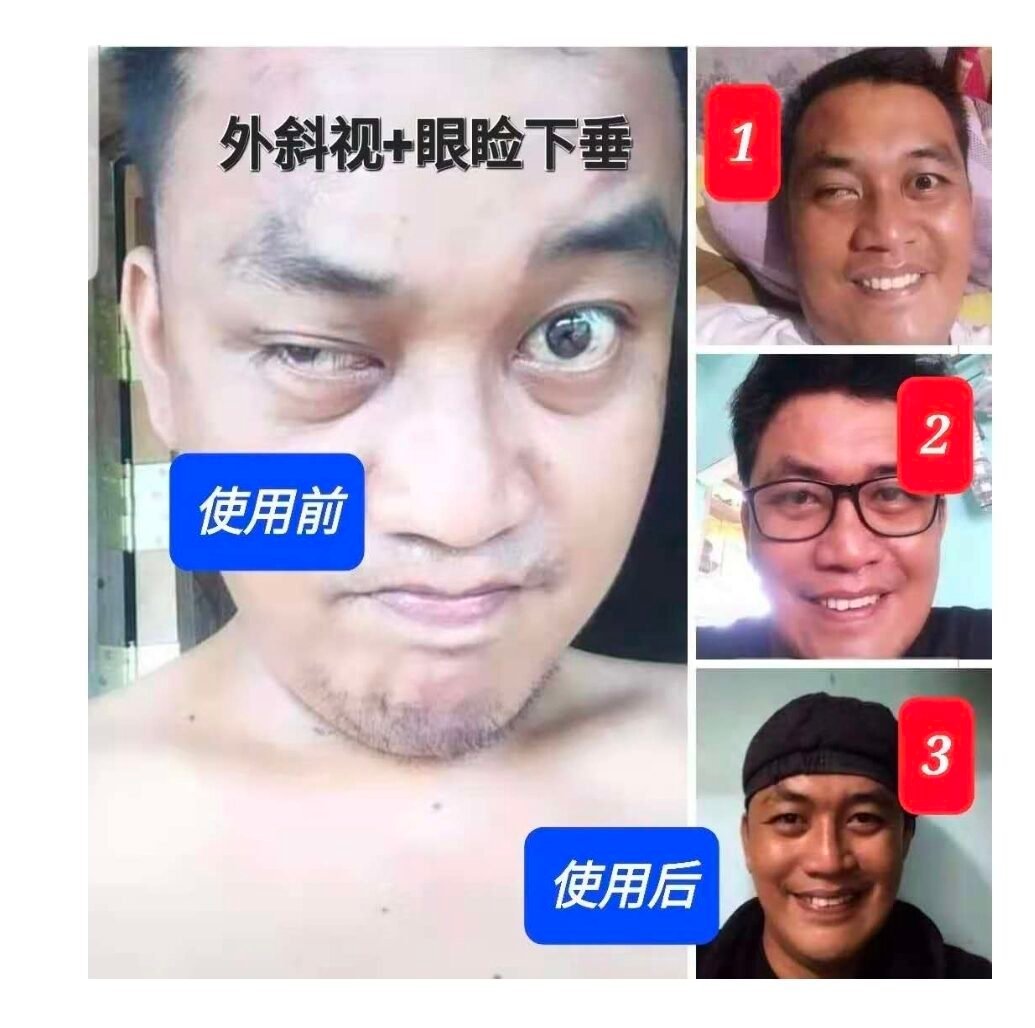 懒惰眼临床成功案例