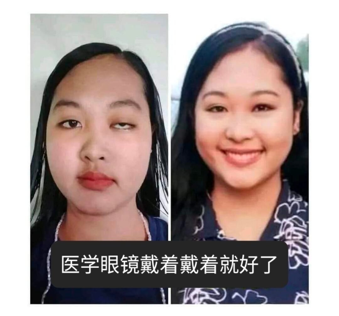 眼睑下垂临床成功案例