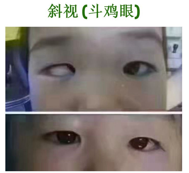 斜视（斗鸡眼）
