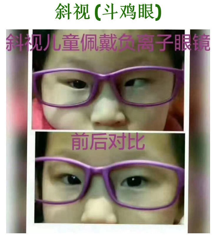 斜视（斗鸡眼）