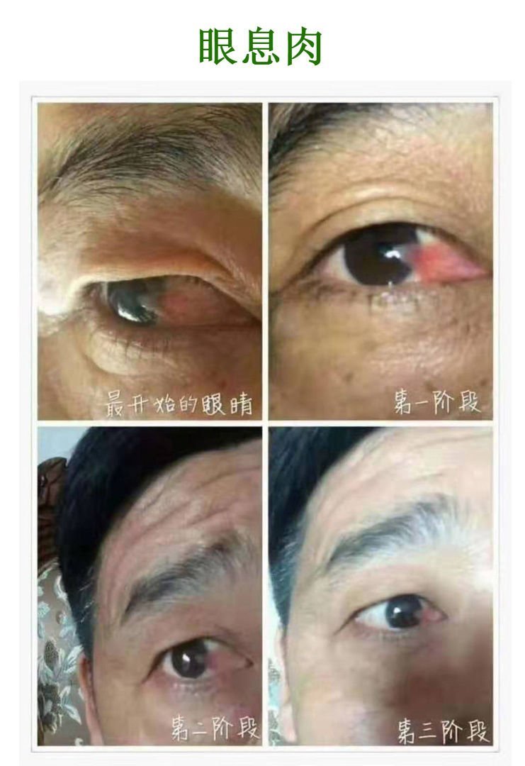 眼息肉