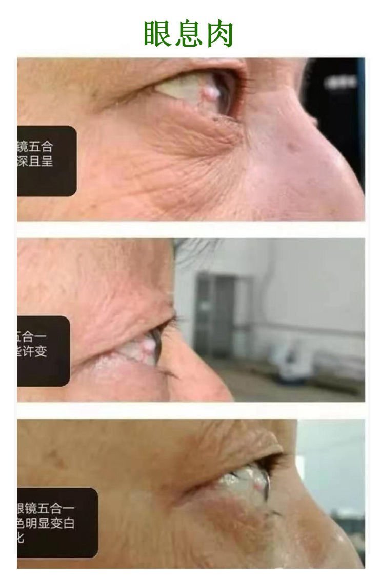 眼息肉