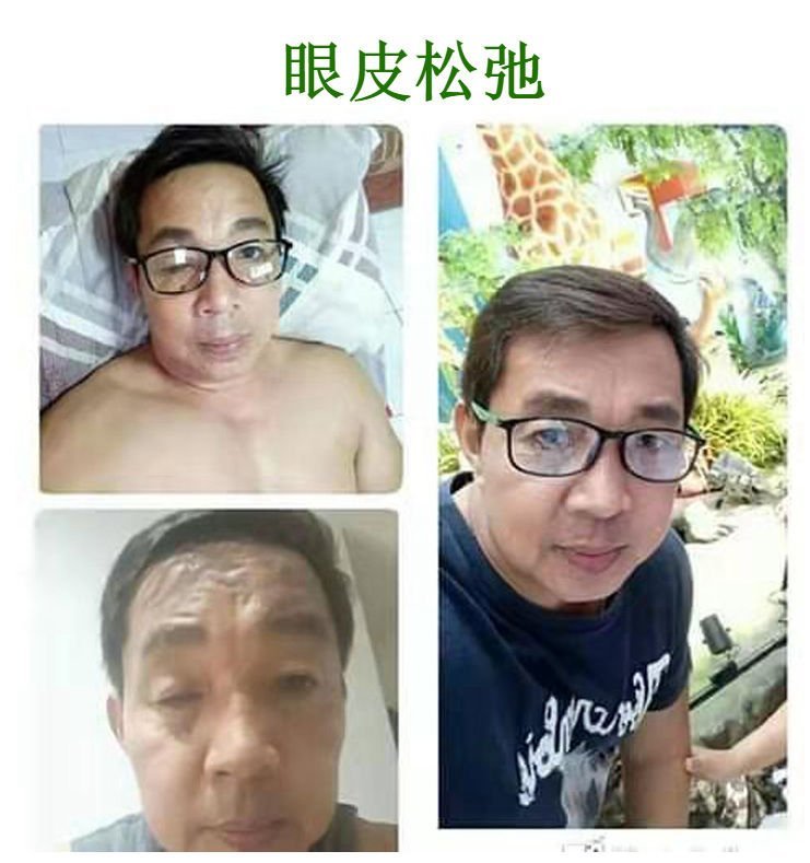 眼皮松弛