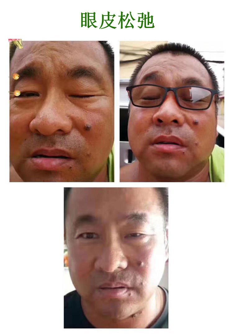 眼皮松弛