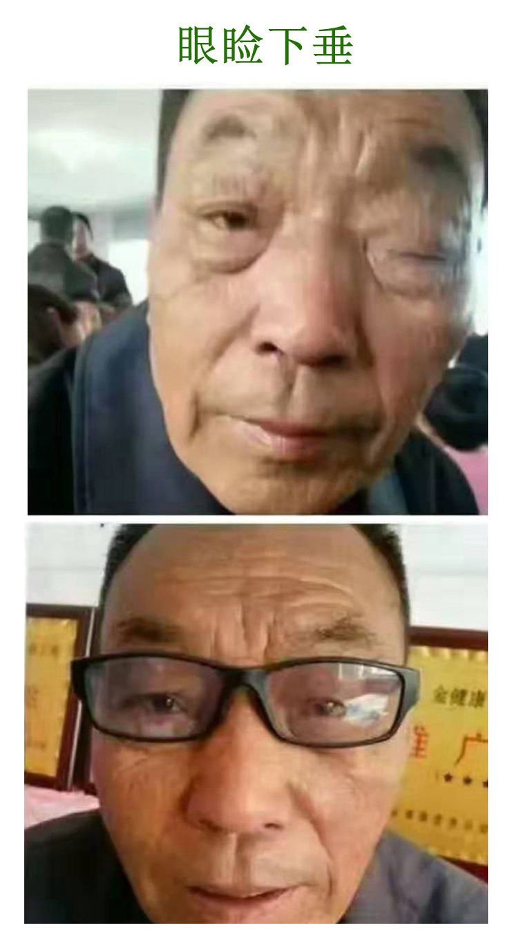 眼睑下垂