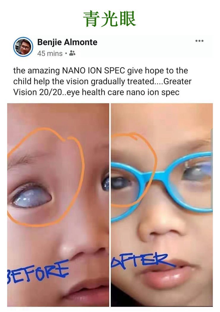 青光眼